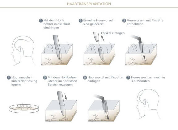 Graphik zum Ablauf einer Haartransplantation - Graphik zum Ablauf einer Haartransplantation - AEZM Hair, Haarzentrum in München