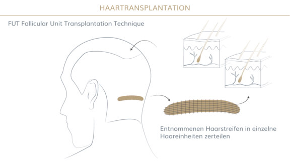 Graphik zur FUT Methode der Haartransplantation - Graphik zum Ablauf einer Haartransplantation - AEZM Hair, Haarzentrum in München